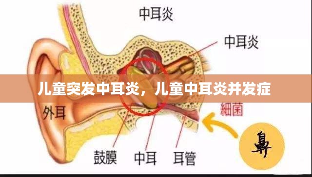 兒童突發(fā)中耳炎，兒童中耳炎并發(fā)癥 